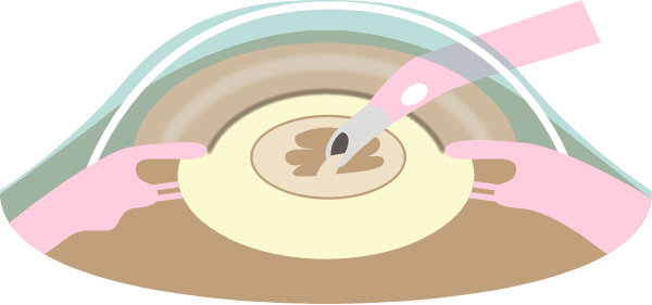 水晶体乳化吸引
